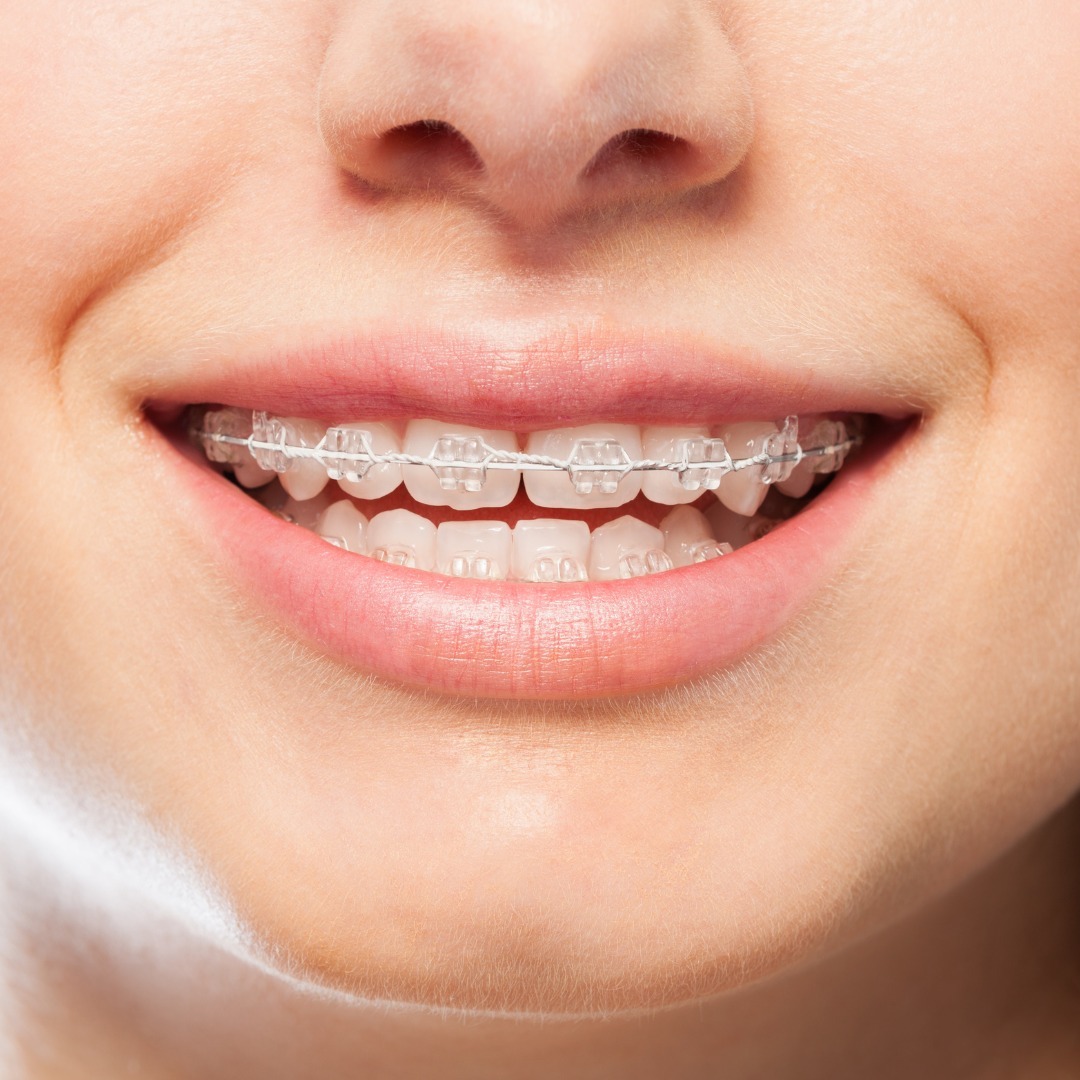 Lingual braces cost in North Las Vegas 