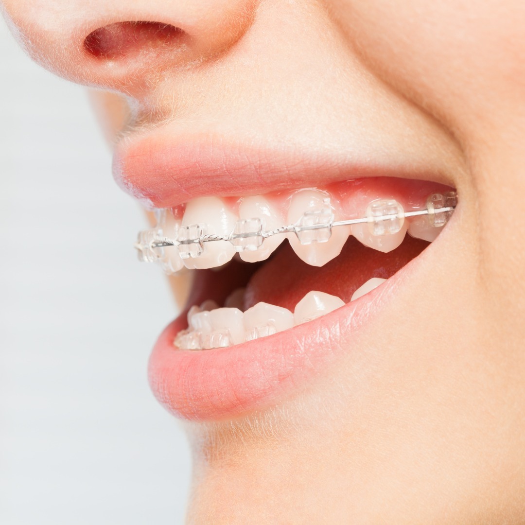 Invisible Braces cost in North Las Vegas